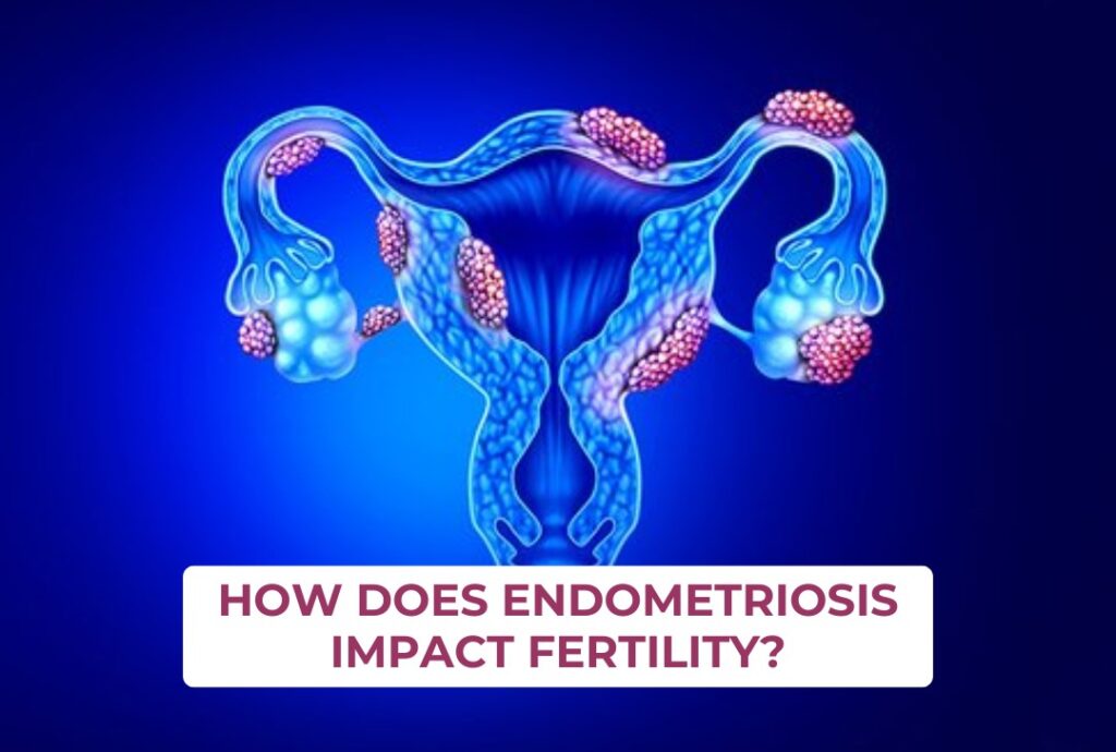 How Does Endometriosis Impact Fertility?