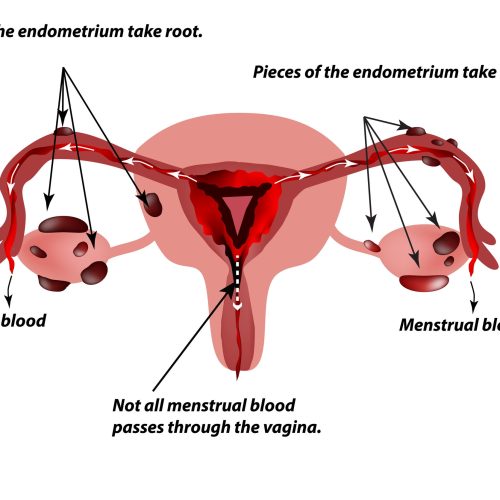 Edited+retrograde+menstruation