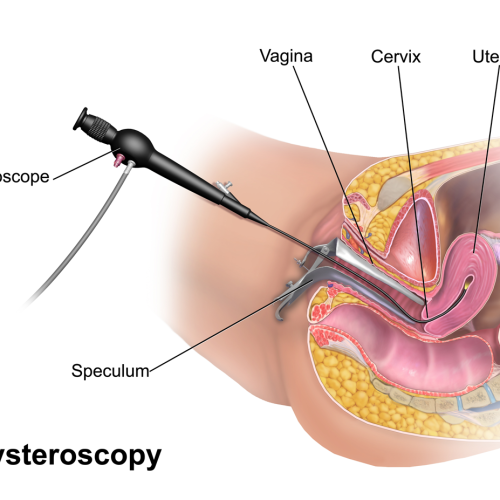 Hysteroscopy