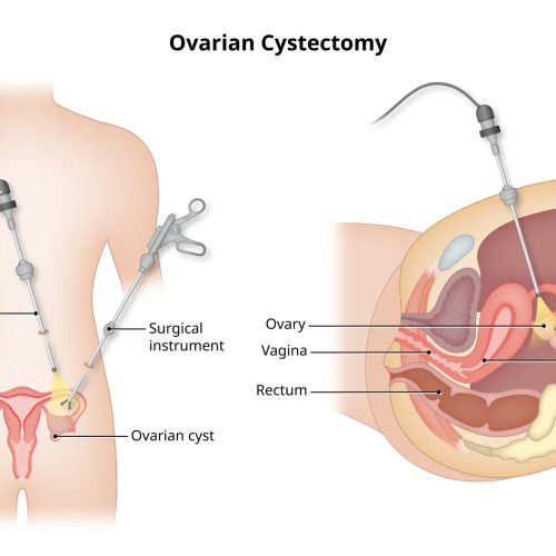 Ovarian Cystectomy