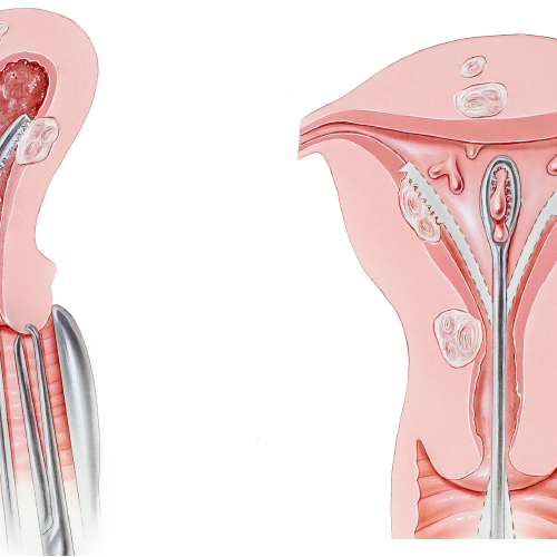 Septal Resection