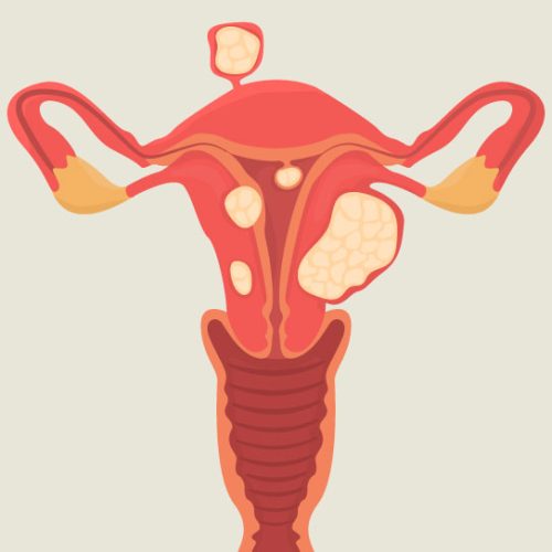 Uterine-Fibroids (1)