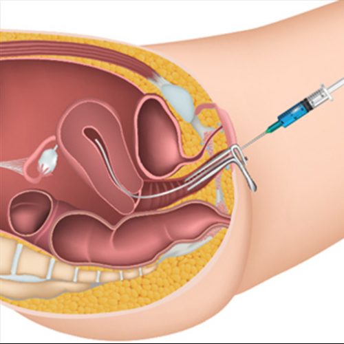 iui-Drnishamangal