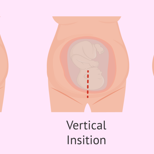 types-cesarean-section